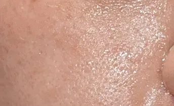 ก่อนทำ: Potenza Microneedling บนผิวหน้า - เคส 13