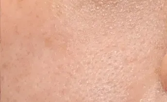 ก่อนทำ: Potenza Microneedling บนผิวหน้า - เคส 14