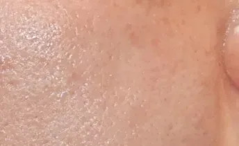 ก่อนทำ: Potenza Microneedling บนผิวหน้า - เคส 15