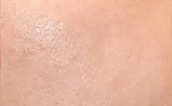 ก่อนทำ: Potenza Microneedling บนผิวหน้า - เคส 16