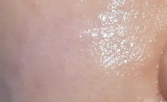 ก่อนทำ: Potenza Microneedling บนผิวหน้า - เคส 17
