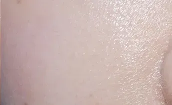 ก่อนทำ: Potenza Microneedling บนผิวหน้า - เคส 18