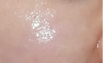 ก่อนทำ: Potenza Microneedling บนผิวหน้า - เคส 19