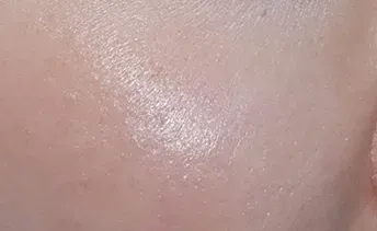 ก่อนทำ: Potenza Microneedling บนผิวหน้า - เคส 20