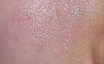 ก่อนทำ: Potenza Microneedling บนผิวหน้า - เคส 21