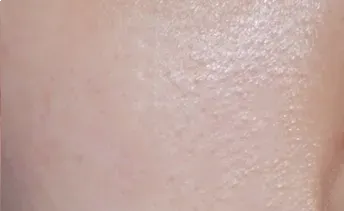 ก่อนทำ: Potenza Microneedling บนผิวหน้า - เคส 22
