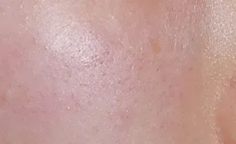 ก่อนทำ: Potenza Microneedling บนผิวหน้า - เคส 23