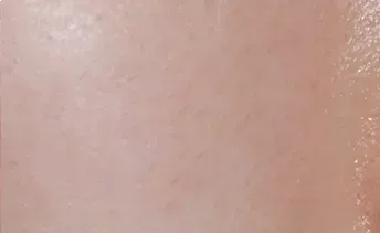 ก่อนทำ: Potenza Microneedling บนผิวหน้า - เคส 24