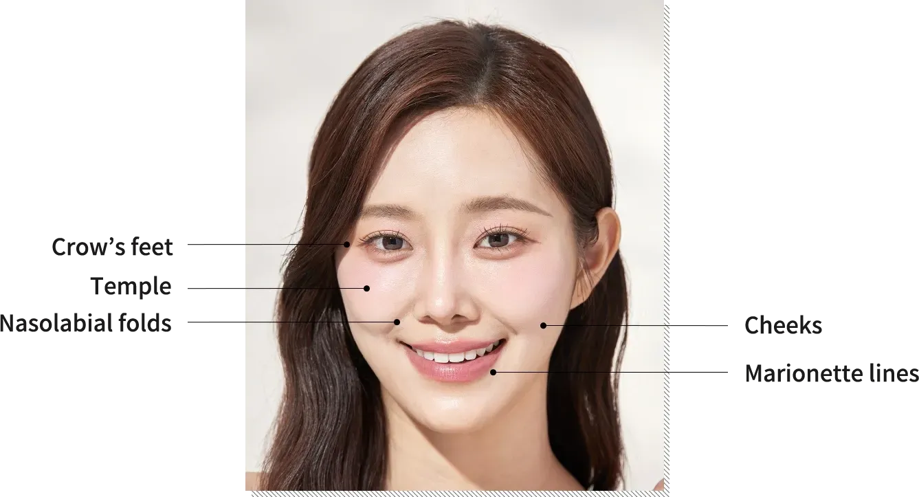 Sculptra 的治疗部位 — 首尔江南 Yaan Clinic
