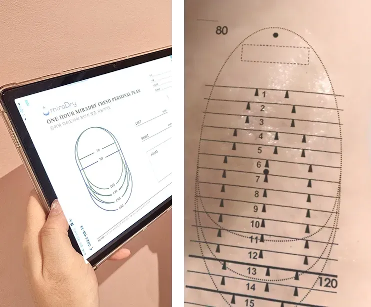 ソウル江南 Yaan Clinic の、お一人ひとりに合わせた miraDry プラン