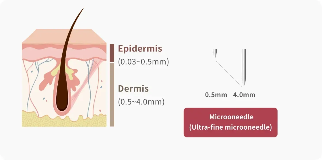 ส่งพลังงานคลื่นความถี่สูงผ่านเข็มไมโครขนาดเล็กมาก - Potenza Microneedling