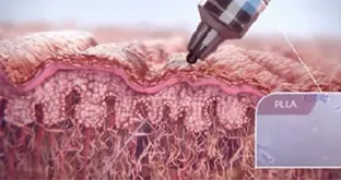 Sculptra 的治疗原理 — 首尔江南 Yaan Clinic