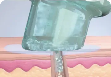 HydraFacial 原理 - 首尔江南 Yaan Clinic