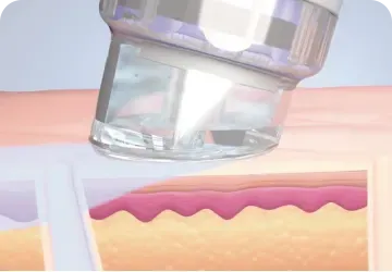 补水强化 Booster - 首尔江南 Yaan Clinic 的 Hydrafacial Smoothing