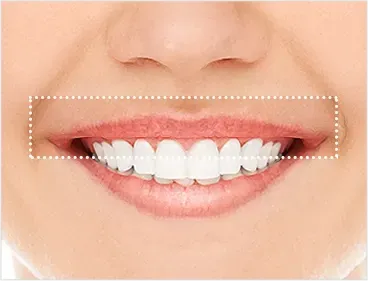 院内照片:首尔江南 Yaan Clinic 露龈笑 Botox 的优势