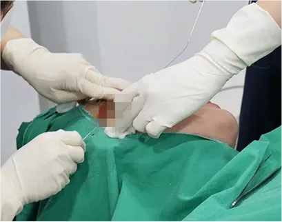 ภาพในคลินิก: ขั้นตอน Eye Lifting ที่ Yaan Clinic