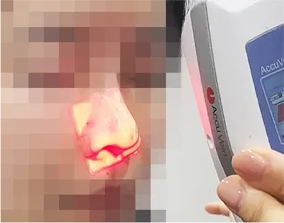 ภาพในคลินิก: การฉีด Skinplus Hyal ที่ Yaan Clinic ย่านกังนัม กรุงโซล