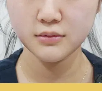 หลังทำ 1 เดือน: Time Lock Tuneface บริเวณใบหน้า - เคส 3