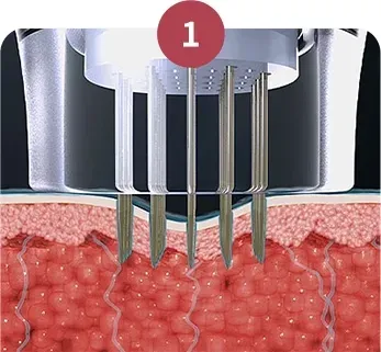 การสัมผัสผิวและการเล็งเป้าหมาย - Potenza Microneedling ที่ Yaan Clinic ย่านกังนัม กรุงโซล