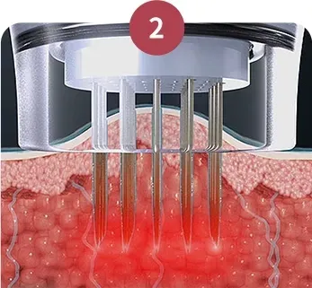 การส่งพลังงาน RF - Potenza Microneedling ที่ Yaan Clinic ย่านกังนัม กรุงโซล