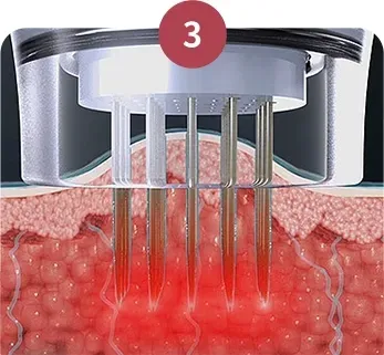 การเกิดโซนการแข็งตัวของเนื้อเยื่อ - Potenza Microneedling ที่ Yaan Clinic ย่านกังนัม กรุงโซล
