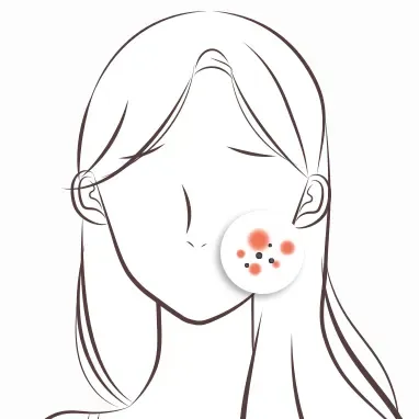 依据肌肤困扰定制的 HydraFacial 套餐 - 首尔江南 Yaan Clinic