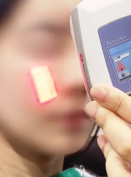 AccuVein|Sculptra(Yaan Clinic 江南·首尔)